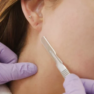 dermaplaning_-00_01_45_03-still011__001198 dermaplaning_-00_01_45_03-still011__001198